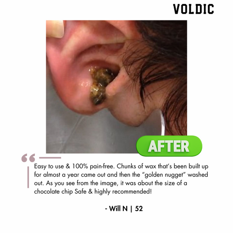 Voldic™ Electric Ear Wax Removal Kit  - Black Friday Sales