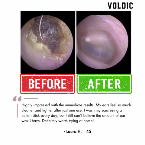 Voldic™ Electric Ear Wax Removal Kit  - Black Friday Sales